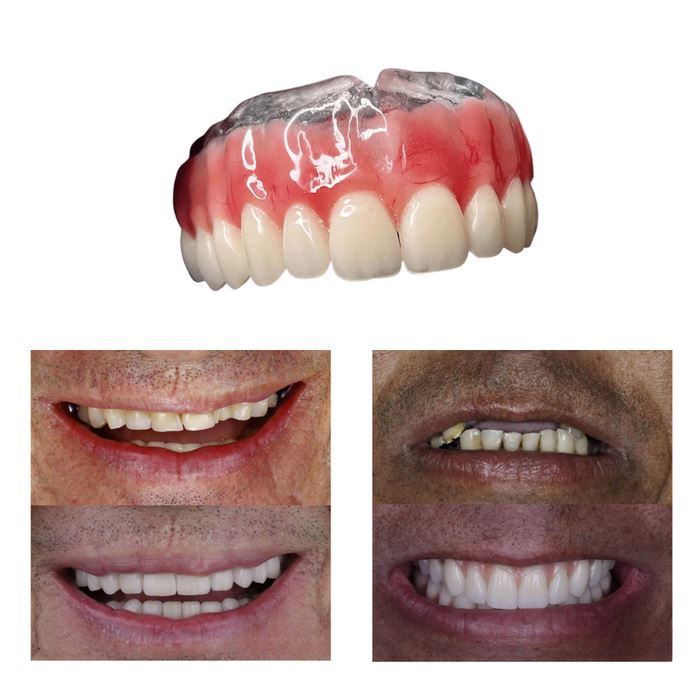 Dentadura de Silicone FIX | Ajustavel e Adaptativa